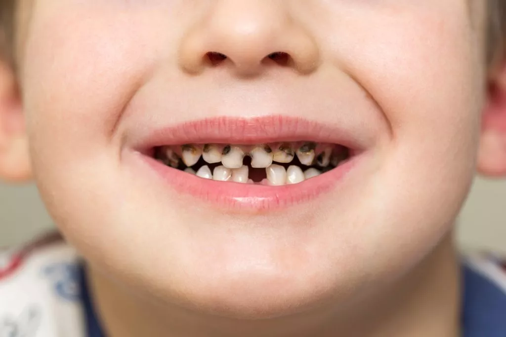 Как защитить зубы малыша от полости и других заболеваний