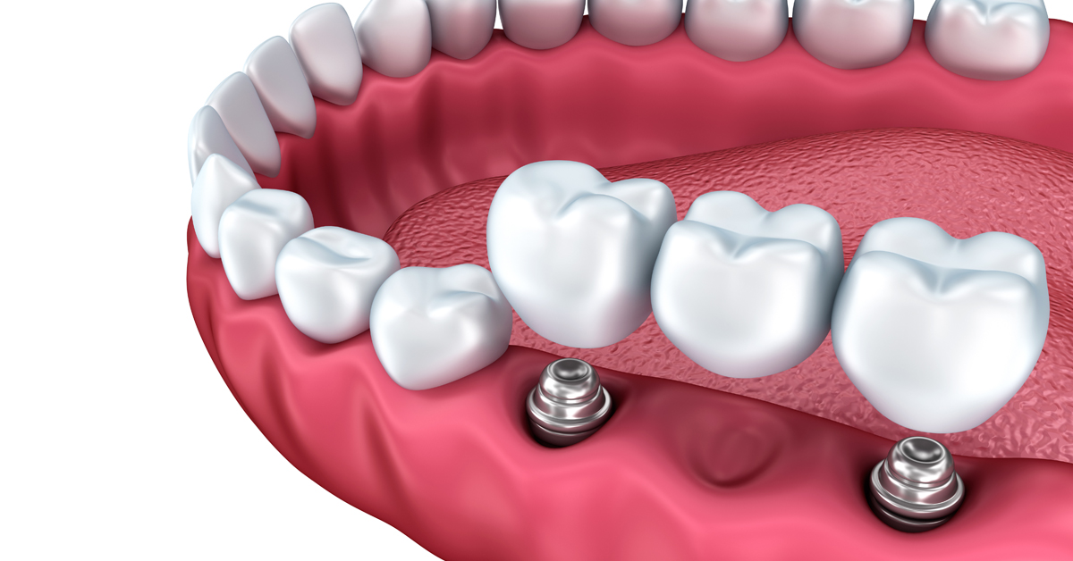 Импланты и несъемные зубные протезы