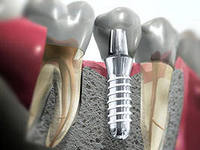 Установка зубных имплантов и их преимущества
