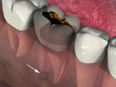 Основные причины зубной боли